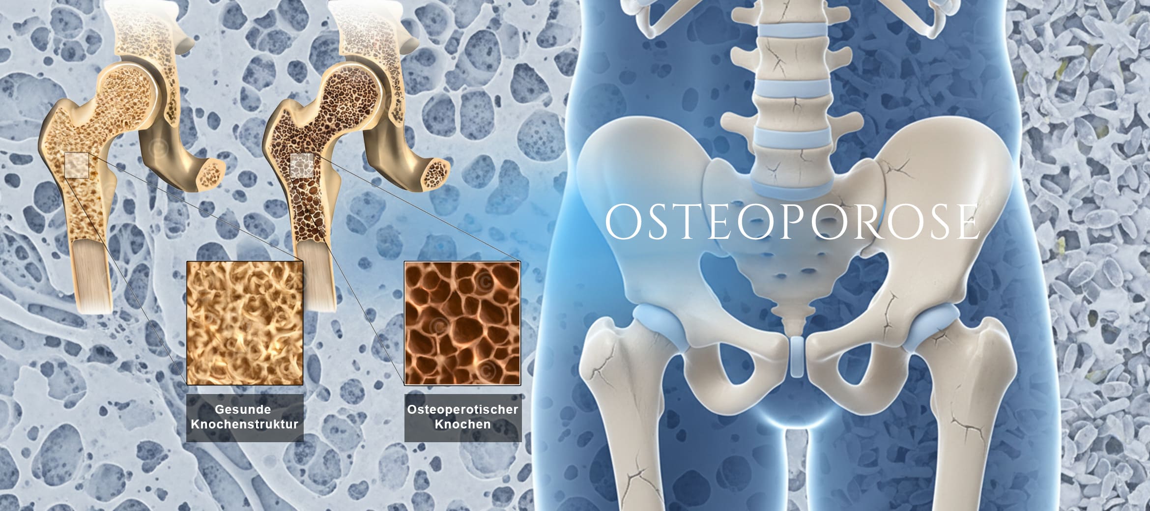 Darstellung Gesundheit Osteoporose mit Hintergrund und Knochendarstellung Hüftbereich und zusätzlicher Knochenschnittbild links als gesunde und Osteoperotischer Knochenstruktur